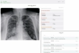ИИ-сервис анализа рентгенограмм внедрен в московское здравоохранение